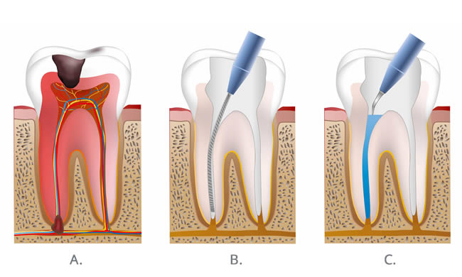 Root Canal Treatment